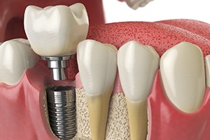 Digital illustration of how to get dental implants in Palm Bay 