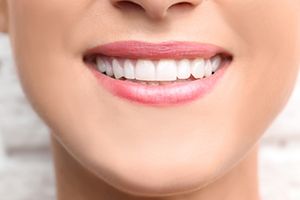 Woman smiling with clearcorrect tray in place