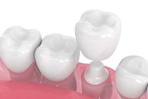 Illustration of dental crown in Palm Bay