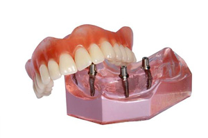 Model of implant supported denture