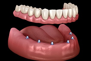 six dental implants supporting a full denture 