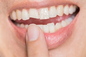 Chipped tooth before emergency dental treatment