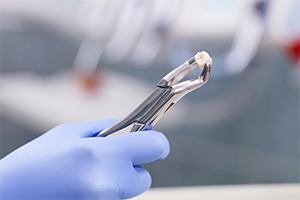 Metal clasp holding extracted tooth