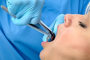 Closeup of patient during tooth extraction