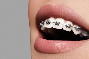 An up-close view of a person’s mouth who is wearing metal braces along the top row of teeth