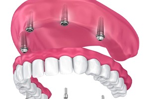 four dental implants supporting an implant denture on upper arch