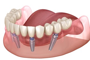 full implant denture on lower arch