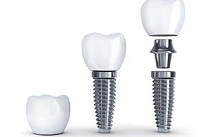 dental implant crown, abutment, and post