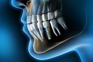 X-ray of a person with a single dental implant