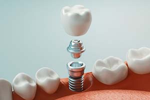 illustration of how dental implants work