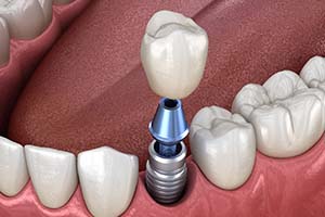 single dental implant supporting a dental crown