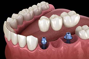 two dental implants supporting a dental bridge