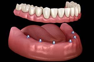 six dental implants supporting a full denture