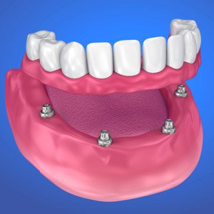 digital model of dental implant supported denture