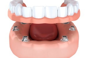 Animted implant-retained denture