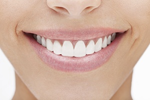 Closeup of a woman's flawless smile after sclaing and root planing treatment