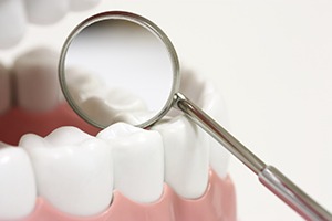 Dentist examining teeth with mirror after dental sealant placement