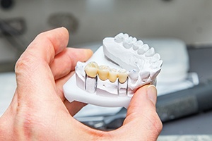 Hand holding model of lower teeth with fixed bridge restoration