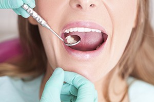 Woman being examined with dental mirror after tooth-colored filling treatment