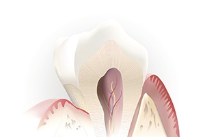 Cartoon depiction of root canal therapy
