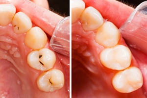 Smile before and after tooth-colored fillings