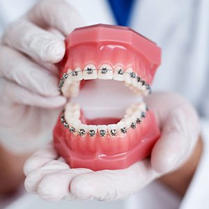 braces on a model of teeth