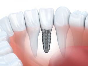 Dental Implant