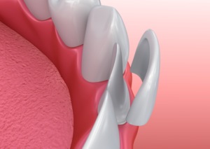 Dental model of porcelain veneers in Palm Bay.