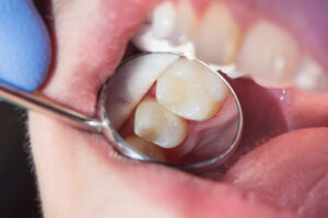 Close up of tooth-colored filling in dental mirror